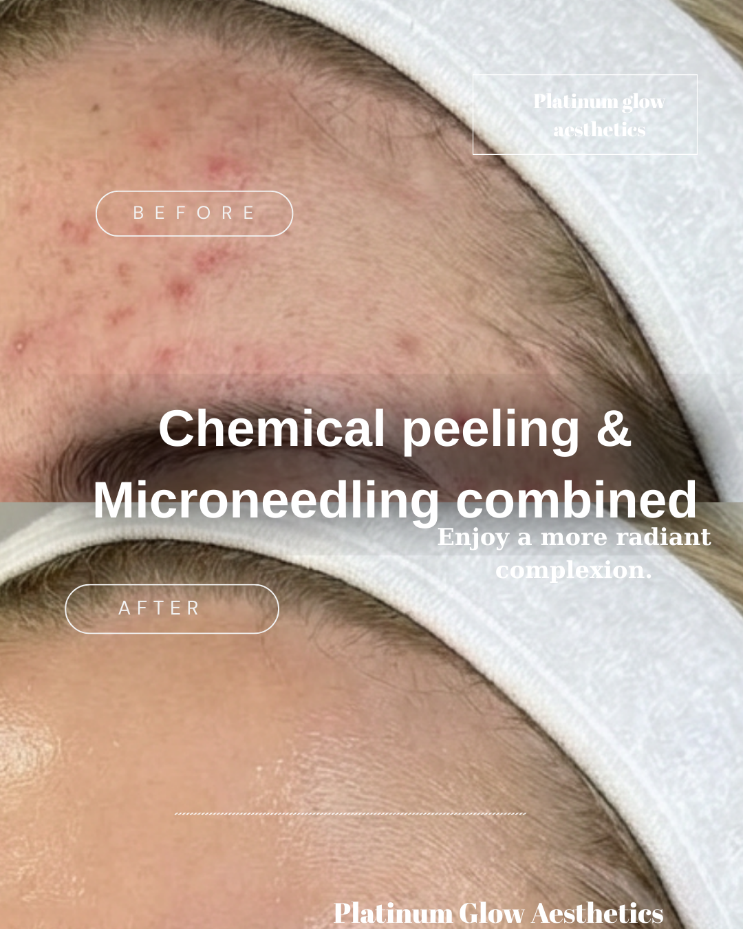 Microneedling facial treatment at Platinum Glow Aesthetics clinic
